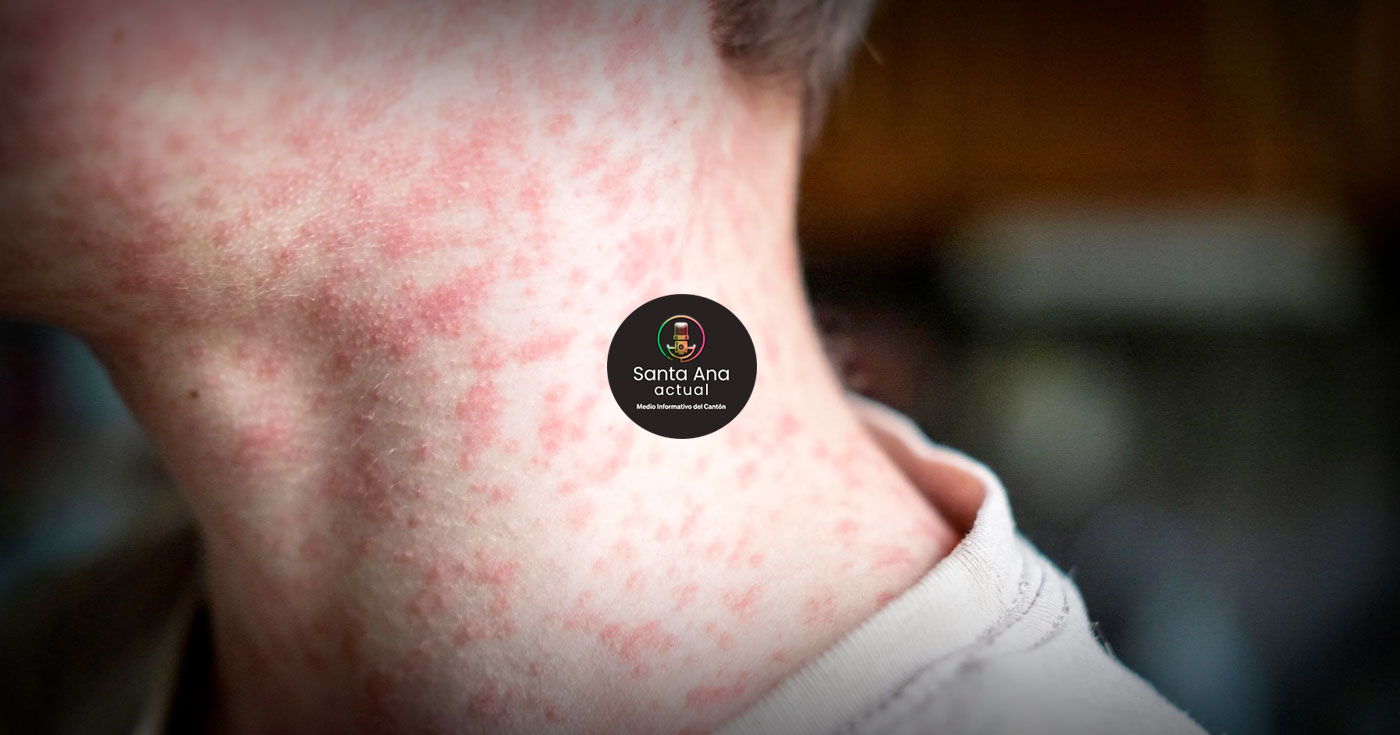 Ministerio de Salud refuerza controles y vacunación tras aumento regional de sarampión